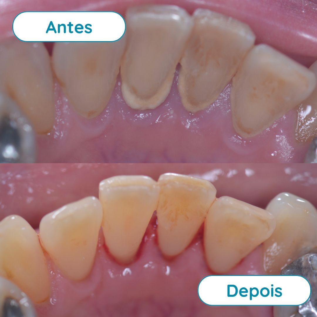 Raspagem Supragengival (limpeza)