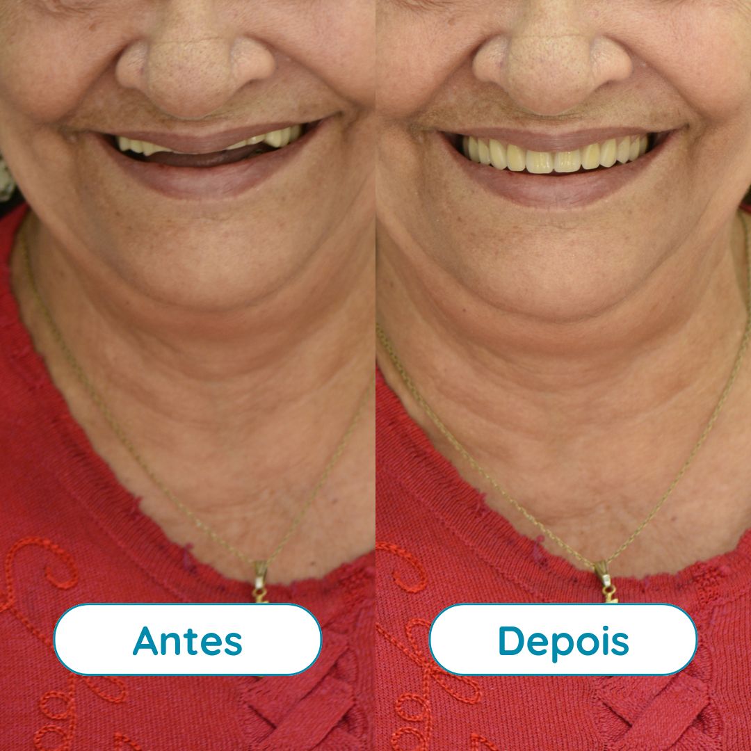 Prótese Total