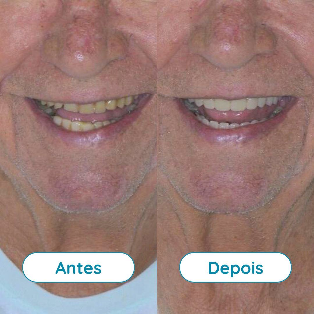Prótese Total
