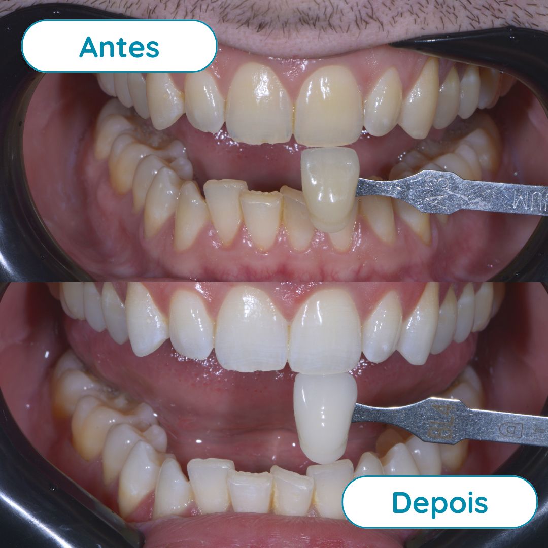 Clareamento Dental