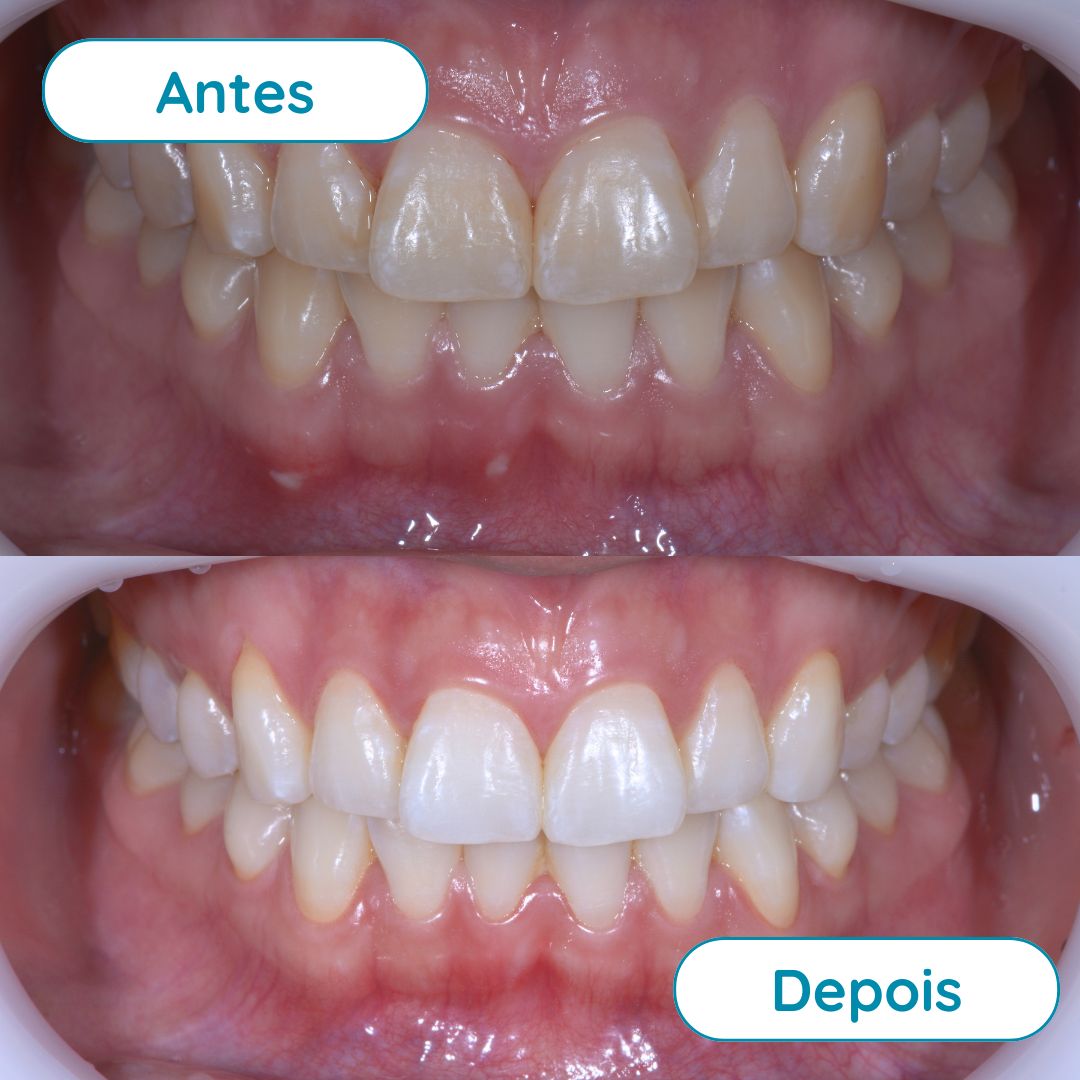 Clareamento Dental